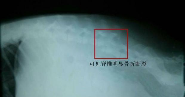 图2  X光片显示，骨折断裂明显
