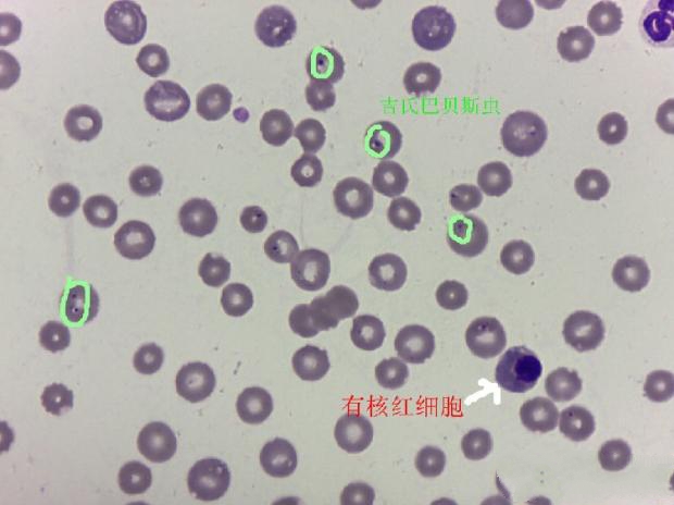 有核红细胞及大量带有虫体的红细胞