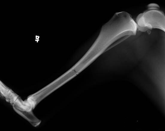 X光侧位显示胫骨骨干骨折