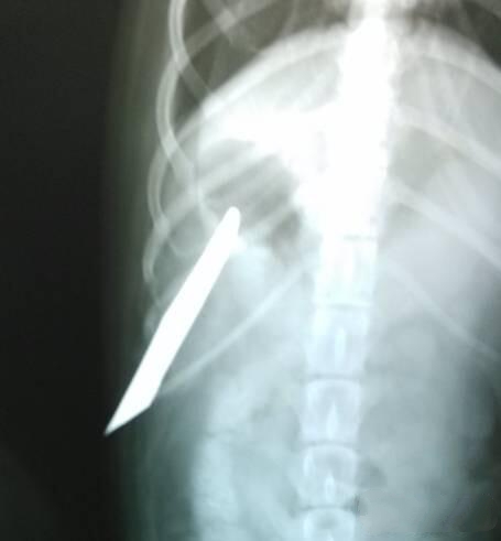X光腹背位探查刀刺入的深度和宽度