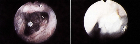 图3：患鼻曲霉菌病的犬的外鼻孔进行鼻镜检查，可以看到鼻甲的缺失以及棕红色的肉芽肿和白色的真菌斑块