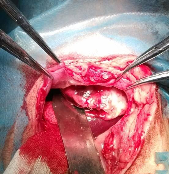  经检查后，麻醉备皮后，由刀口位置切开皮肤探查刀刺入位置，看到刀深入胃部，胃部有切口。