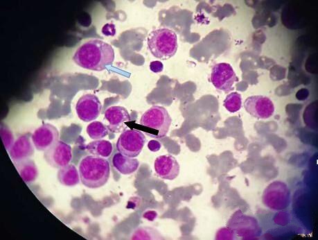 患有传染性性病肿瘤的犬的阴道细胞学检查，传染性性病肿瘤细胞呈圆形或者椭圆形，富含蓝色胞浆，细胞核多是位于细胞的一侧，细胞核突出（如图蓝色箭头所示），细胞质内可见数量不等的透明空泡（图中黑色箭头所示）。