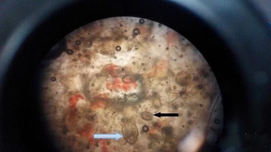  显微镜下，疥螨和卵。蓝色箭头为螨虫成虫，黑色箭头为螨虫卵。在一个视野下看到一只螨虫和多个螨虫卵，说明此次感染处在活动期。