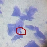 这是一张显微镜下的马拉色菌图片，是囡囡在做皮肤病胶带法镜检时拍摄的，某个视野下的单个马拉色菌：圆圈中花生样的及时马拉色菌，其他有透明感且的不规则的都是角质细胞。